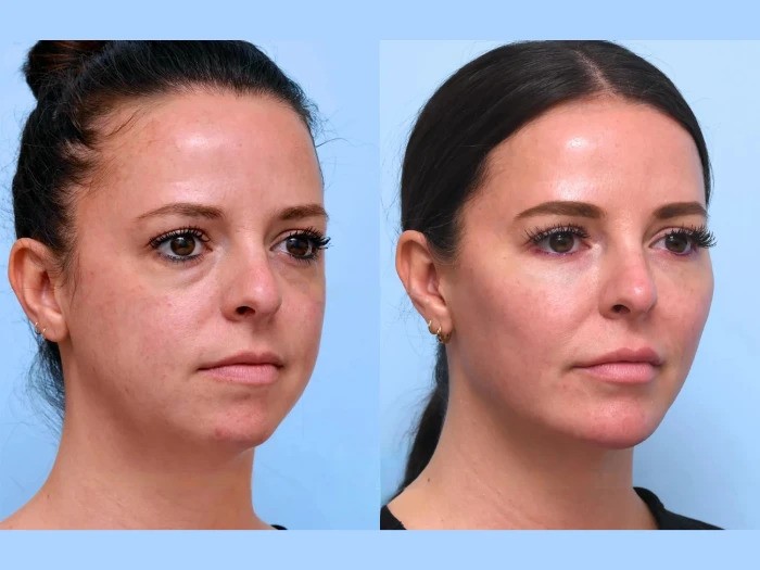 Precision Thread Lift Treatments in Dubai for Balanced Facial Contours