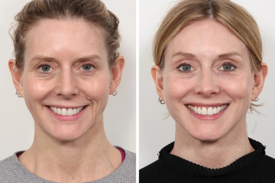 Thread lift in Dubai