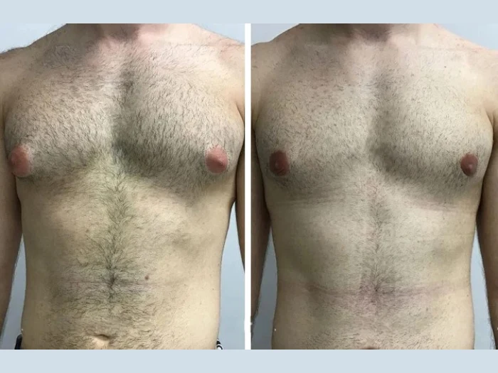gynecomastia in Dubai
