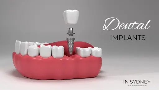 dental implants in sydney