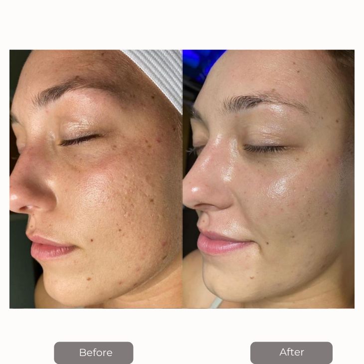 Is HydraFacial Safe at Islamabad Beauty Clinics?