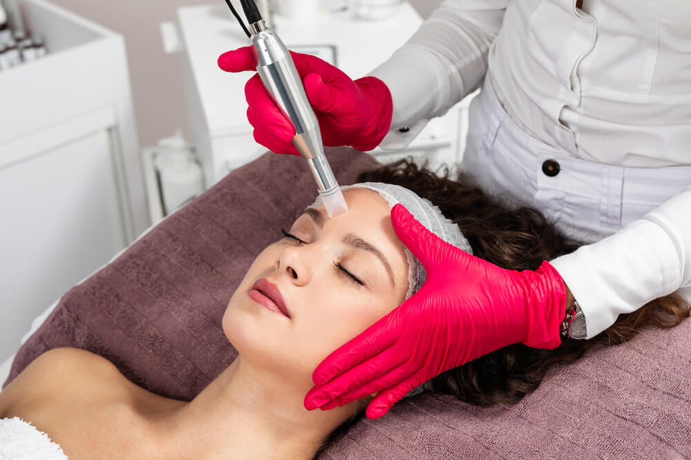 Affordable microneedling treatment in San Francisco clinic