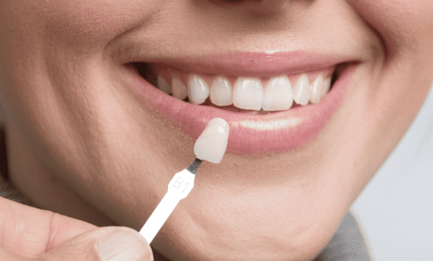 Hollywood Smile makeover in Dubai